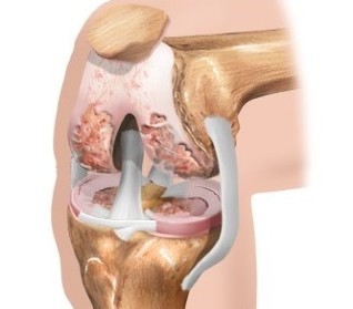 The cartilage in the knee